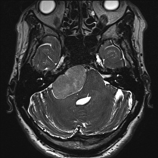 Cerebellopontine angle meningioma (Radiopaedia 72983-83680 Axial FIESTA 33).jpg