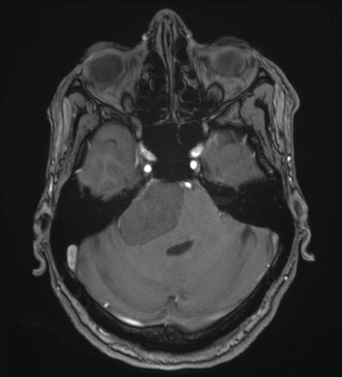 Cerebellopontine angle meningioma (Radiopaedia 72983-83680 Axial MRA 31).jpg