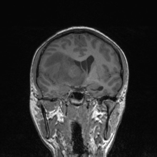 Cerebral abscess (Radiopaedia 24212-24478 Coronal T1 100).jpg