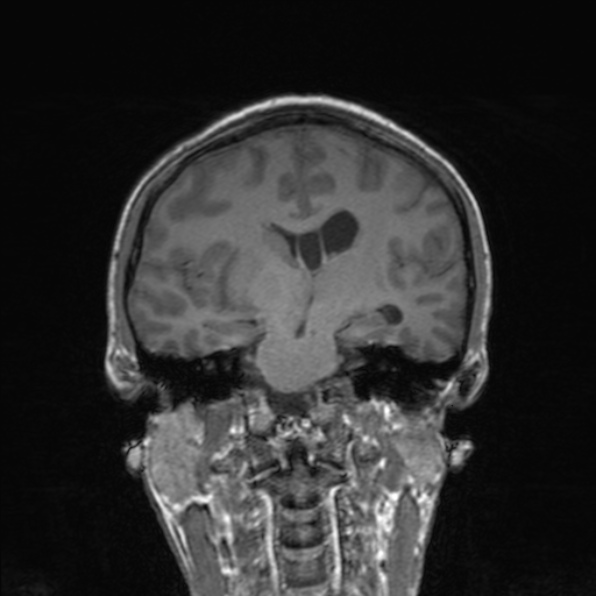 Cerebral abscess (Radiopaedia 24212-24478 Coronal T1 117).jpg