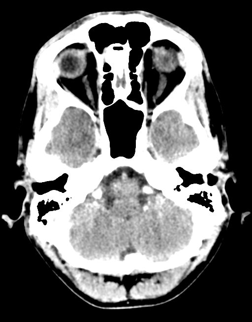 Cerebral abscess (Radiopaedia 60342-68008 Axial C+ delayed 11).png