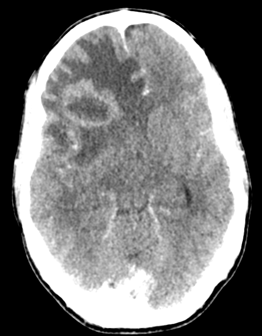 Cerebral abscess (Radiopaedia 60342-68008 Axial C+ delayed 23).png
