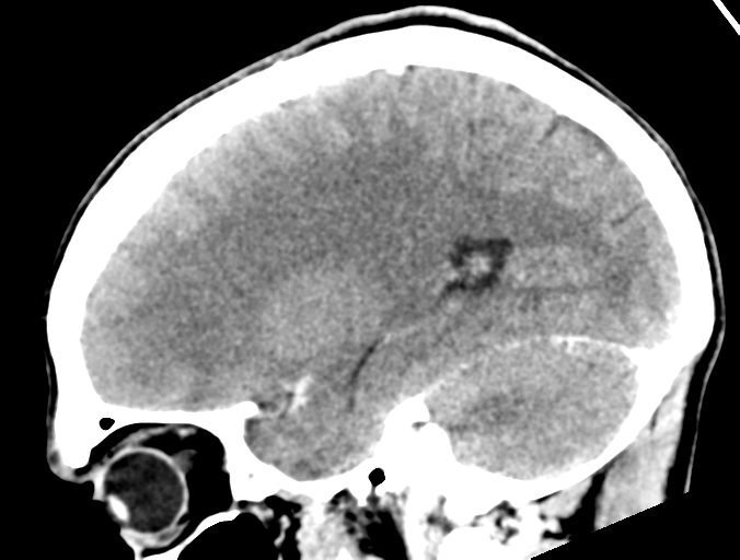 Cerebral abscess (Radiopaedia 60342-68008 Sagittal C+ delayed 17).png