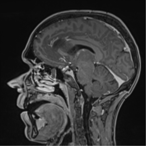 Cerebral abscess (Radiopaedia 60342-68009 J 27).png