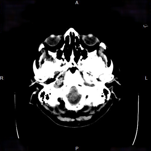 File:Cerebral abscess (Radiopaedia 7606-8431 Axial non-contrast 7).jpg