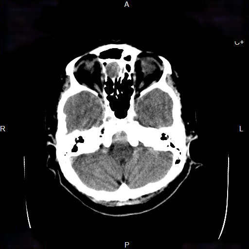 File:Cerebral abscess (Radiopaedia 7606-8432 Axial C+ delayed 2).jpg