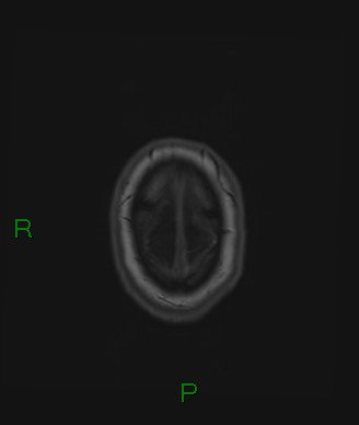 Cerebral abscess and subdural empyema (Radiopaedia 84436-99779 Axial T1 10).jpg