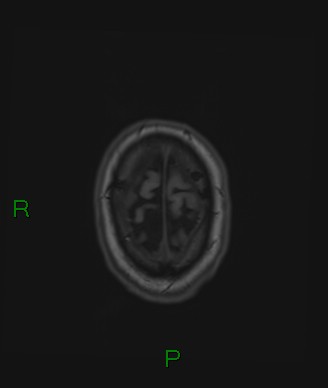 File:Cerebral abscess and subdural empyema (Radiopaedia 84436-99779 Axial T1 12).jpg