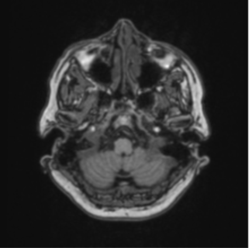 Cerebral abscess from pulmonary arteriovenous malformation (Radiopaedia 86275-102291 Axial T1 14).png