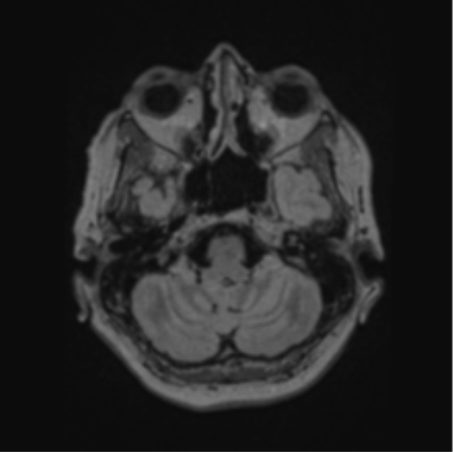 Cerebral abscess from pulmonary arteriovenous malformation (Radiopaedia 86275-102291 J 19).png