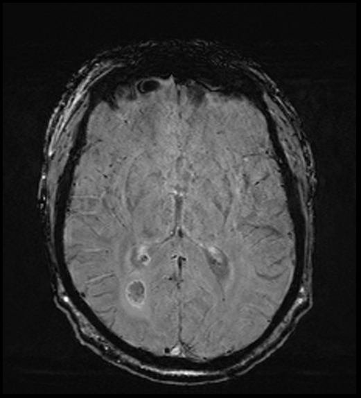 Cerebral abscess with ventriculitis (Radiopaedia 78965-91878 Axial SWI 29).jpg