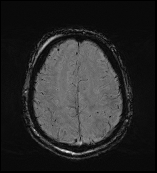 Cerebral abscess with ventriculitis (Radiopaedia 78965-91878 Axial SWI 41).jpg