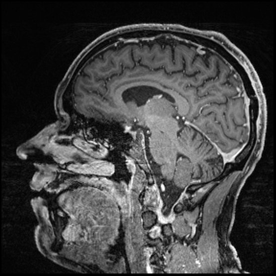 Cerebral abscess with ventriculitis (Radiopaedia 78965-91878 Sagittal T1 C+ 84).jpg