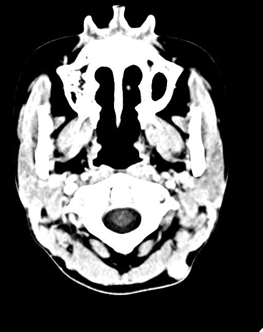 Cerebral abscesses (Radiopaedia 70458-80568 Axial Contrast 7).jpg