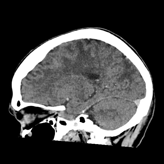 Cerebral amyloid angiopathy-related inflammation (Radiopaedia 74836-85848 C 38).jpg