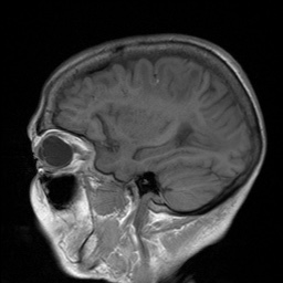 File:Cerebral amyloid angiopathy-related inflammation (Radiopaedia 74836-85849 Sagittal T1 24).jpg