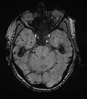 File:Cerebral amyloid angiopathy (Radiopaedia 46082-50433 Axial SWI 25).png