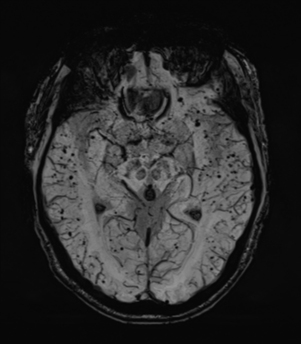 Cerebral amyloid angiopathy (Radiopaedia 46082-50433 Axial SWI MIP 34).png