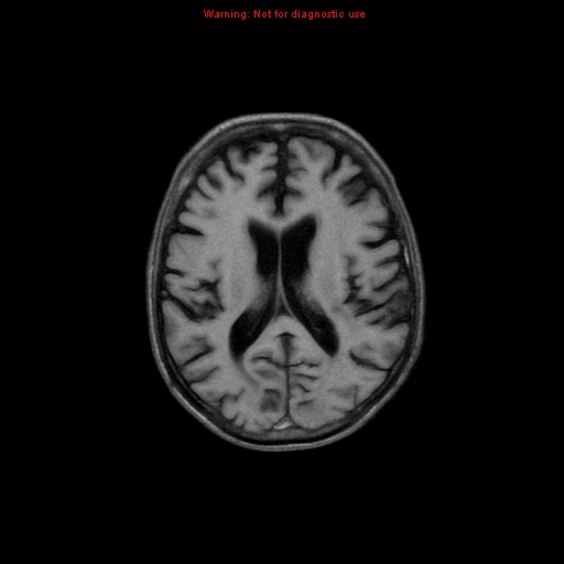 File:Cerebral and orbital tuberculomas (Radiopaedia 13308-13311 Axial T1 13).jpg