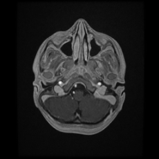 Cerebral and spinal tuberculosis (Radiopaedia 90489-107837 Axial T1 C+ 44).jpg