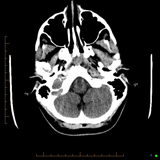Cerebral arteriovenous malformation (AVM) (Radiopaedia 78162-90706 Axial non-contrast 12).jpg