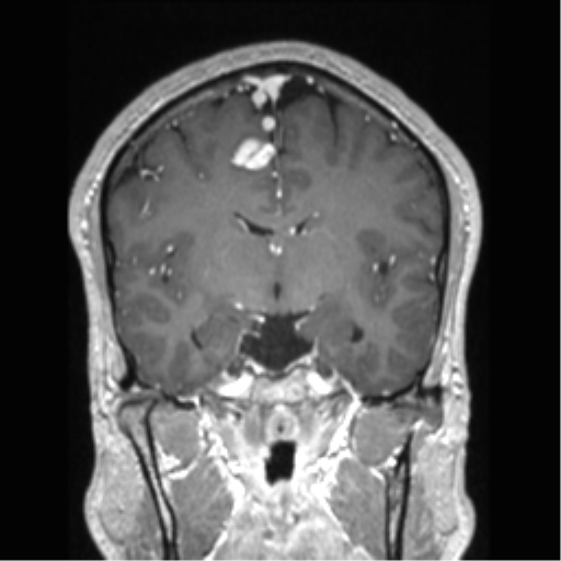 Cerebral arteriovenous malformation (Radiopaedia 39259-41506 Coronal T1 C+ 51).png