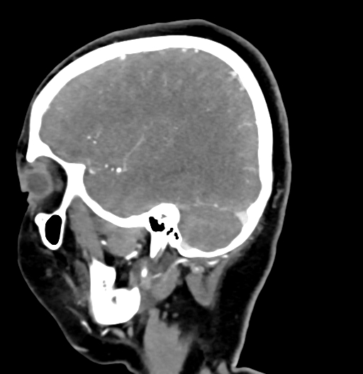Cerebral arteriovenous malformation (Radiopaedia 73830-84645 D 24).jpg