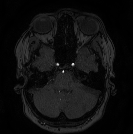 Cerebral arteriovenous malformation (Radiopaedia 74411-85654 Axial MRA 19).jpg