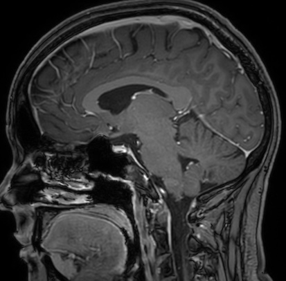 Cerebral arteriovenous malformation (Radiopaedia 74411-85654 Sagittal T1 C+ 62).jpg