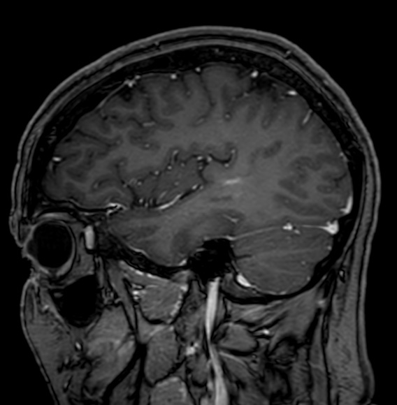 Cerebral arteriovenous malformation (Radiopaedia 74411-85746 Sagittal T1 C+ 28).jpg