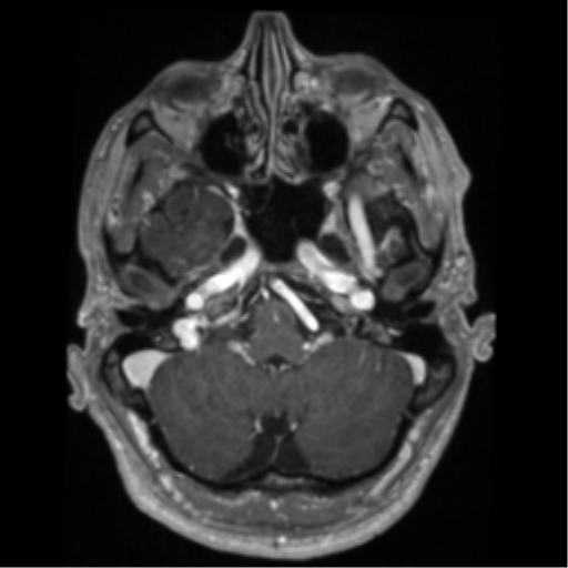 Cerebral arteriovenous malformation - huge (Radiopaedia 35734-37272 Axial T1 C+ 13).png