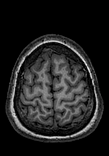 File:Cerebral arteriovenous malformation at posterior body of corpus callosum (Radiopaedia 74111-84925 Axial T1 31).jpg