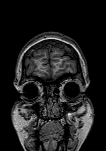 Cerebral arteriovenous malformation at posterior body of corpus callosum (Radiopaedia 74111-84925 Coronal T1 5).jpg