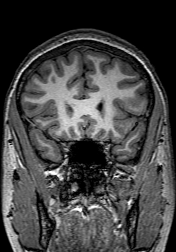 File:Cerebral arteriovenous malformation at posterior body of corpus callosum (Radiopaedia 74111-84925 Coronal T1 89).jpg