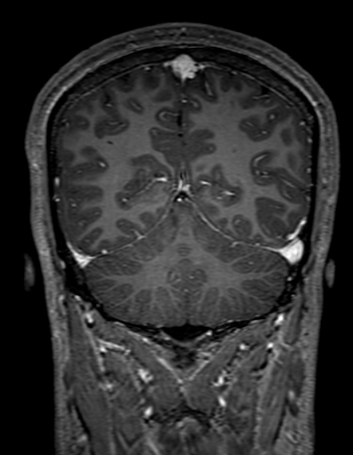 Cerebral arteriovenous malformation at posterior body of corpus callosum (Radiopaedia 74111-84925 K 276).jpg