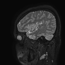Cerebral arteriovenous malformation at posterior body of corpus callosum (Radiopaedia 74111-84925 Sagittal T2 110).jpg