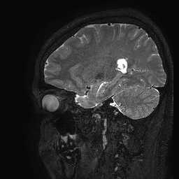 Cerebral arteriovenous malformation at posterior body of corpus callosum (Radiopaedia 74111-84925 Sagittal T2 39).jpg