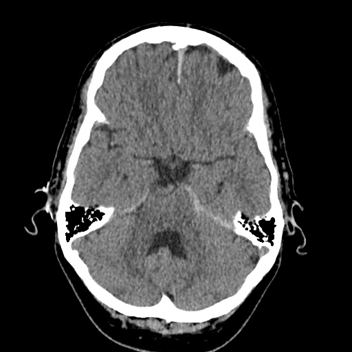 Cerebral arteriovenous malformation with lobar hemorrhage (Radiopaedia 35598-37117 Axial non-contrast 15).jpg