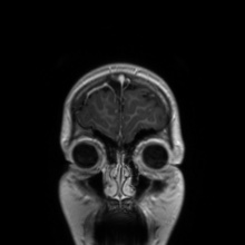 Cerebral cavernous venous malformation (Radiopaedia 70008-80021 Coronal T1 C+ 56).jpg