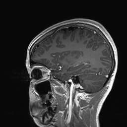 Cerebral cavernous venous malformation (Radiopaedia 70008-80021 Sagittal T1 C+ 21).jpg