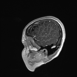 File:Cerebral cavernous venous malformation (Radiopaedia 70008-80021 Sagittal T1 C+ 64).jpg