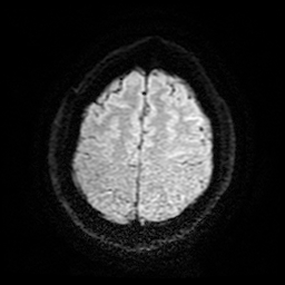 Cerebral cavernous venous malformation (Zabramski type II) (Radiopaedia 85511-101198 Axial DWI 25).jpg