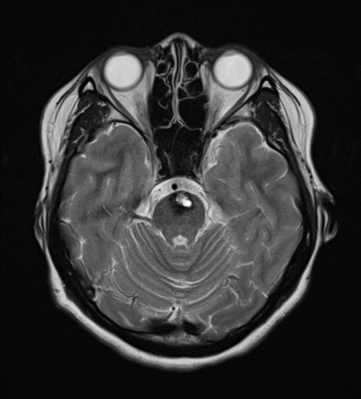 File:Cerebral cavernous venous malformations (Radiopaedia 48117-52946 Axial T2 8).png