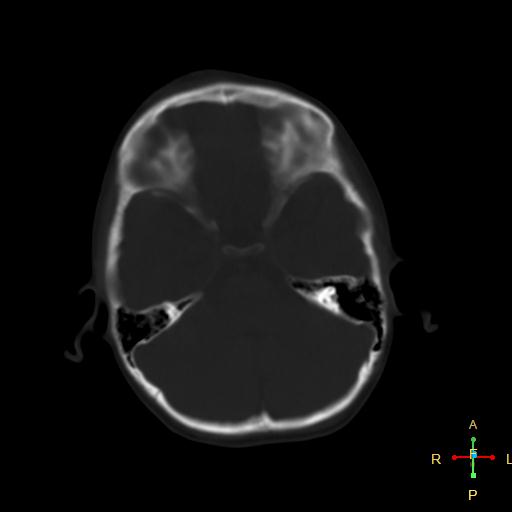 File:Cerebral contusion (Radiopaedia 48869-53911 Axial bone window 16).jpg