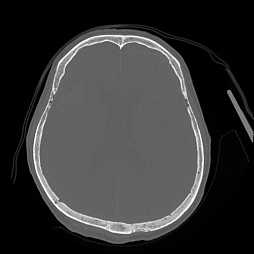 Cerebral contusions, subarachnoid hemorrhage and subdural hygromas (Radiopaedia 55399-61827 Axial bone window 31).png