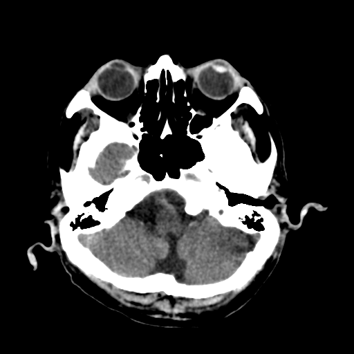 File:Cerebral contusions, subarachnoid hemorrhage and subdural hygromas (Radiopaedia 55399-61827 Axial non-contrast 9).png