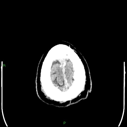 Cerebral contusions (Radiopaedia 33868-35039 Axial non-contrast 208).jpg