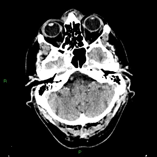 File:Cerebral contusions (Radiopaedia 33868-35039 Axial non-contrast 39).jpg