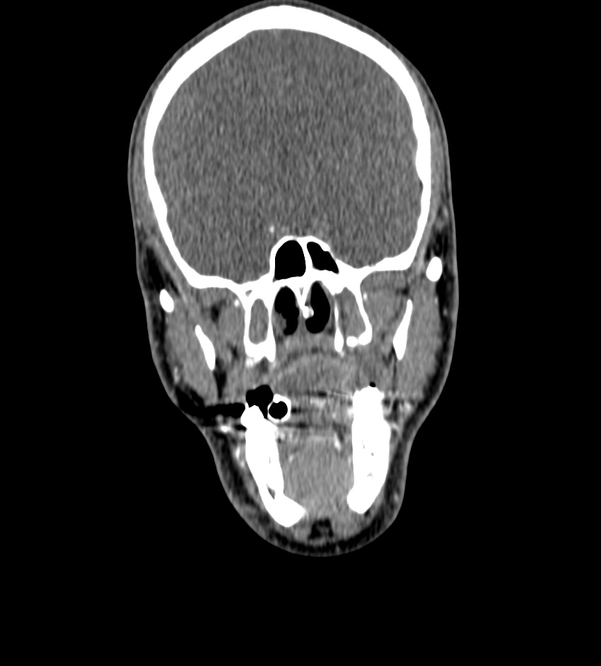 Cerebral edema in an overdose patient (Radiopaedia 72005-82539 B 3).jpg