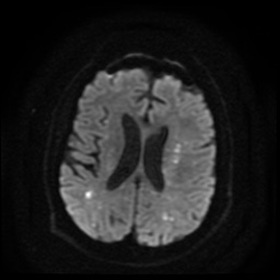 Cerebral embolic infarcts (embolic shower) (Radiopaedia 49837-55108 Axial DWI 66).jpg
